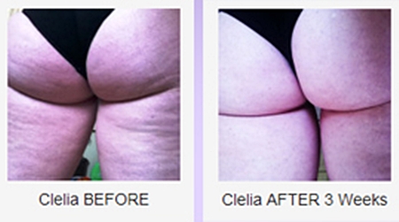 cellulite before and after doing symulast exercises