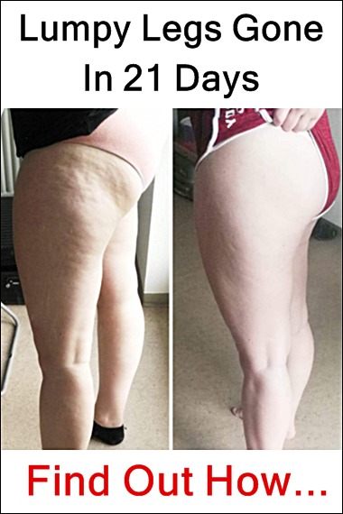 my cellulite solution before and after pictures